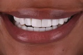 Veneers After